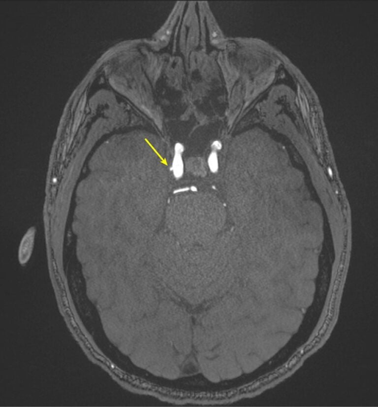 Repeated Blast Exposure Appears to Increase Brain Aneurysms in U.S. Special Operations Forces