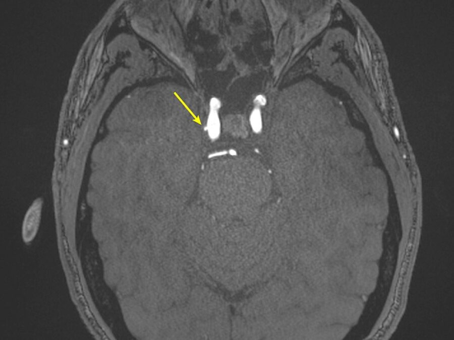 Repeated Blast Exposure Appears to Increase Brain Aneurysms in U.S. Special Operations Forces